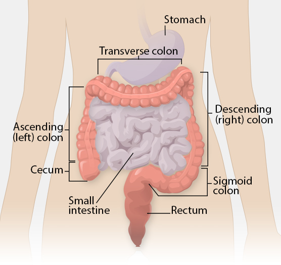 Colorectal Cancer Informational graphic